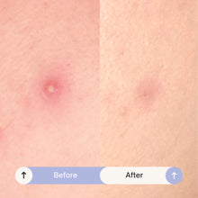 Load image into Gallery viewer, Spotted Nighttime -Hydrocolloid Pimple Patches